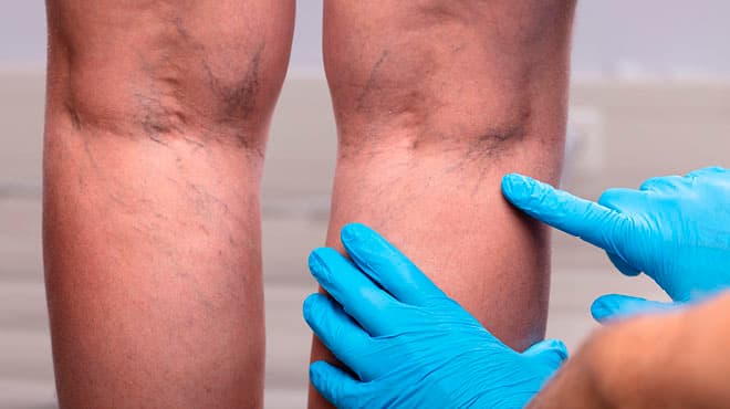 Vein Treatment
